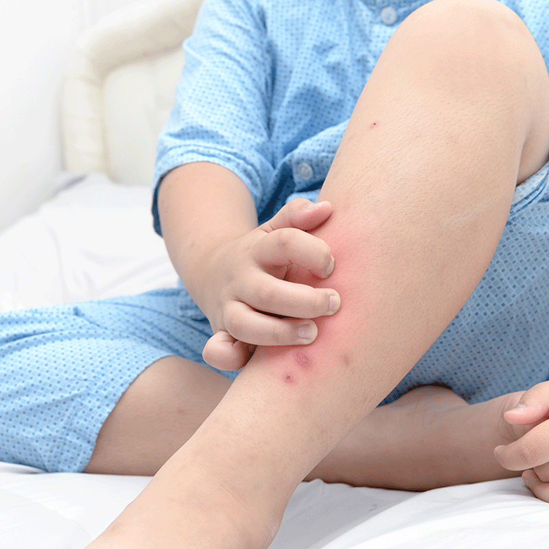 Bed Bug Bites